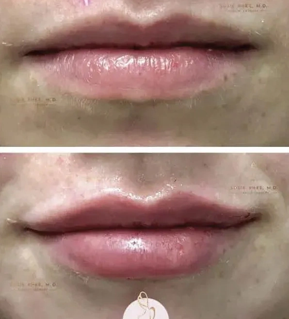 Real patient results before and after plastic surgery results in Long Island, NY, performed by Dr. Sotirios Papafragkou.