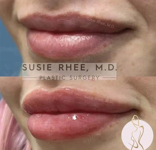 Real patient results before and after plastic surgery results in Long Island, NY, performed by Dr. Sotirios Papafragkou.