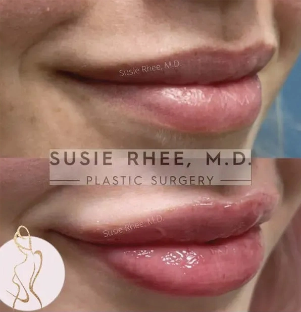 Real patient results before and after plastic surgery results in Long Island, NY, performed by Dr. Sotirios Papafragkou.