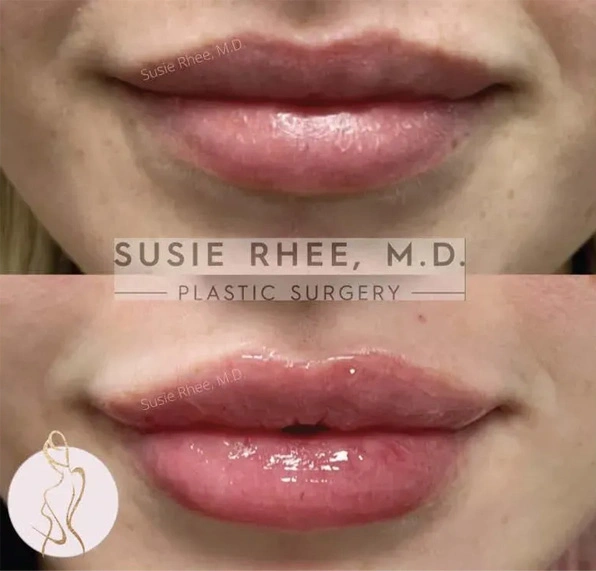 Real patient results before and after plastic surgery results in Long Island, NY, performed by Dr. Sotirios Papafragkou.