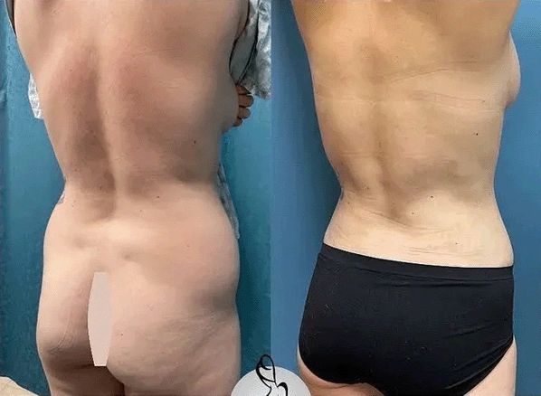 Real patient results before and after plastic surgery results in Long Island, NY, performed by Dr. Sotirios Papafragkou.