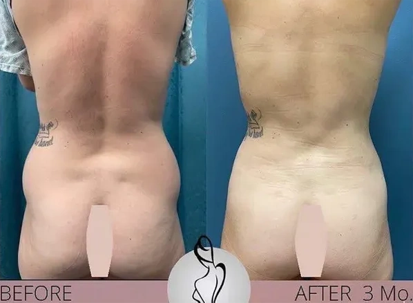 Real patient results before and after plastic surgery results in Long Island, NY, performed by Dr. Sotirios Papafragkou.