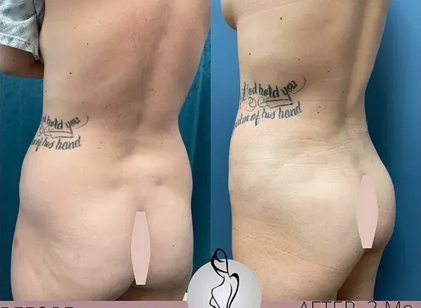 Real patient results before and after plastic surgery results in Long Island, NY, performed by Dr. Sotirios Papafragkou.