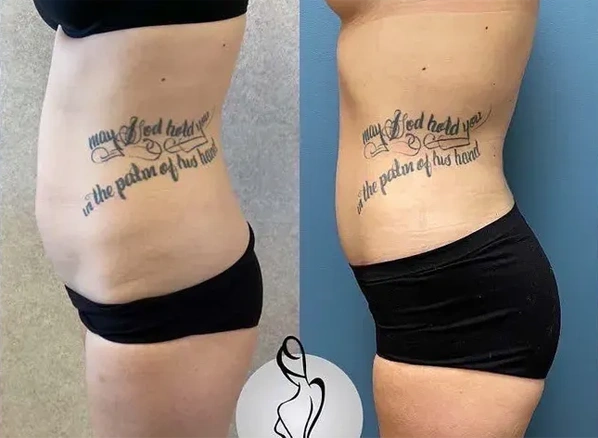 Real patient results before and after plastic surgery results in Long Island, NY, performed by Dr. Sotirios Papafragkou.