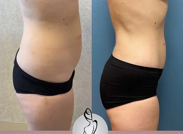 Real patient results before and after plastic surgery results in Long Island, NY, performed by Dr. Sotirios Papafragkou.