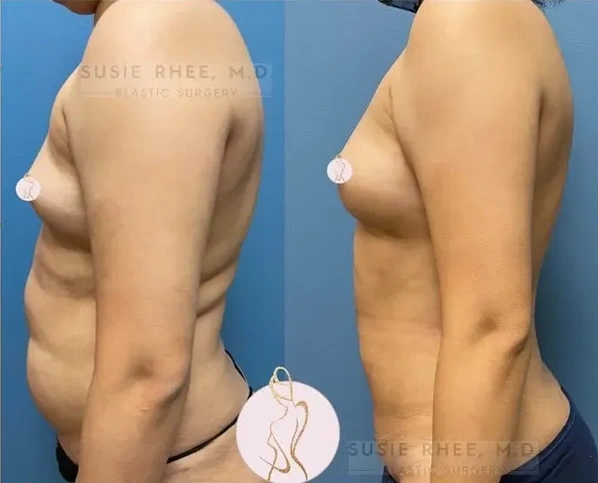 Real patient results before and after plastic surgery results in Long Island, NY, performed by Dr. Sotirios Papafragkou.