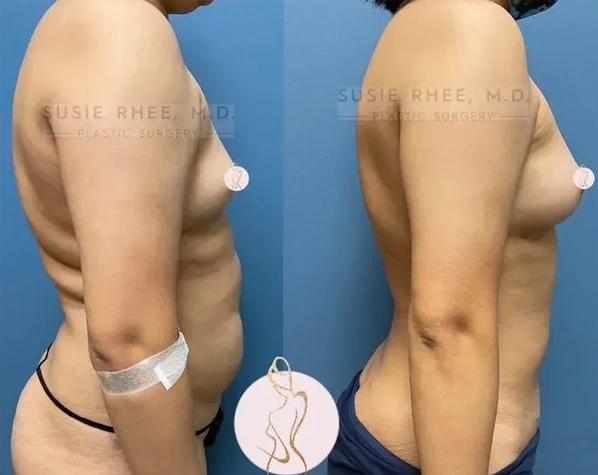 Real patient results before and after plastic surgery results in Long Island, NY, performed by Dr. Sotirios Papafragkou.
