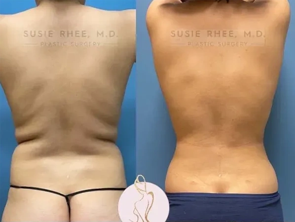 Real patient results before and after plastic surgery results in Long Island, NY, performed by Dr. Sotirios Papafragkou.