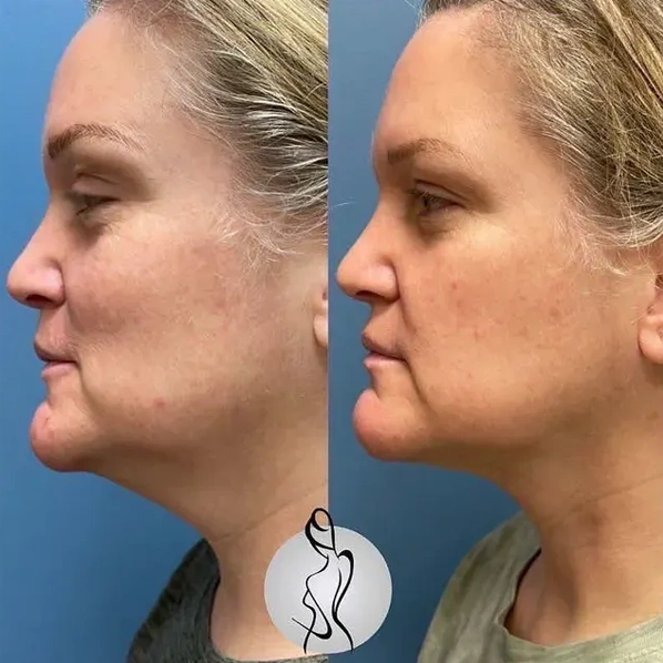 Real patient results before and after plastic surgery results in Long Island, NY, performed by Dr. Sotirios Papafragkou.