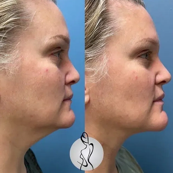 Real patient results before and after plastic surgery results in Long Island, NY, performed by Dr. Sotirios Papafragkou.