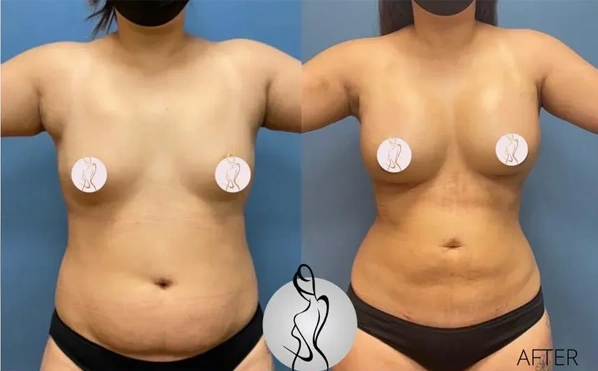 Real patient results before and after plastic surgery results in Long Island, NY, performed by Dr. Sotirios Papafragkou.