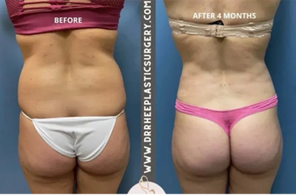 Real patient results before and after plastic surgery results in Long Island, NY, performed by Dr. Sotirios Papafragkou.