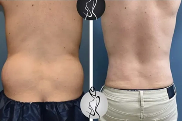 Real patient results before and after plastic surgery results in Long Island, NY, performed by Dr. Sotirios Papafragkou.