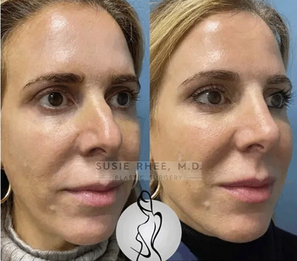 Real patient results before and after plastic surgery results in Long Island, NY, performed by Dr. Sotirios Papafragkou.