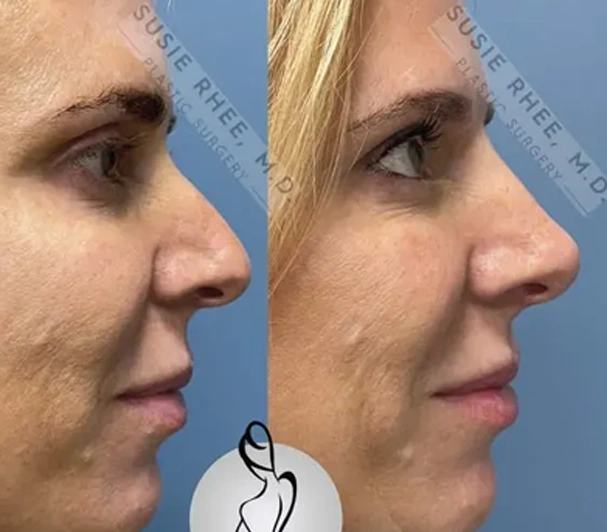 Real patient results before and after plastic surgery results in Long Island, NY, performed by Dr. Sotirios Papafragkou.