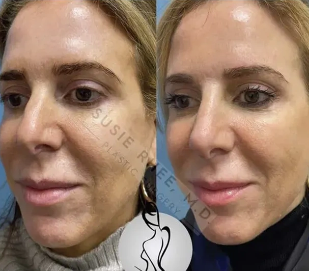 Real patient results before and after plastic surgery results in Long Island, NY, performed by Dr. Sotirios Papafragkou.