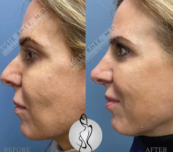 Real patient results before and after plastic surgery results in Long Island, NY, performed by Dr. Sotirios Papafragkou.