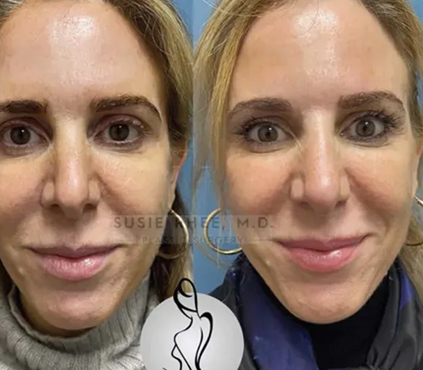 Real patient results before and after plastic surgery results in Long Island, NY, performed by Dr. Sotirios Papafragkou.