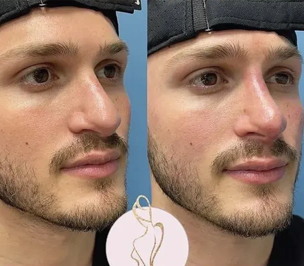 Real patient results before and after plastic surgery results in Long Island, NY, performed by Dr. Sotirios Papafragkou.