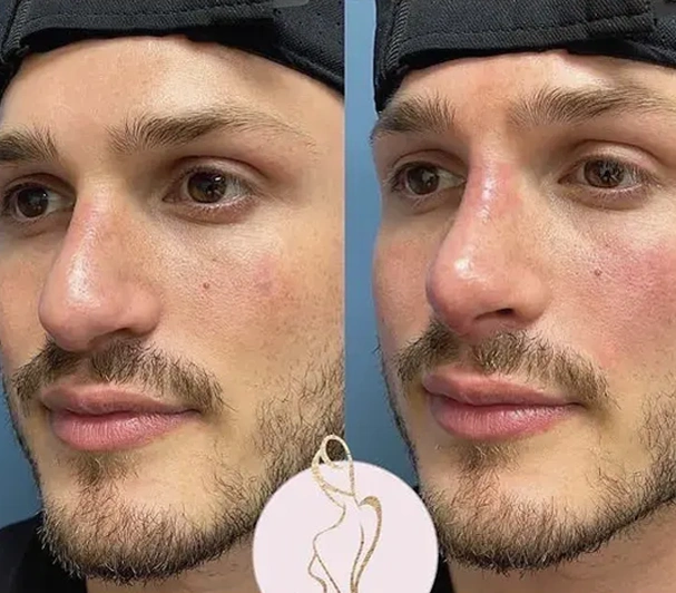 Real patient results before and after plastic surgery results in Long Island, NY, performed by Dr. Sotirios Papafragkou.