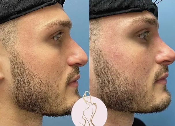 Real patient results before and after plastic surgery results in Long Island, NY, performed by Dr. Sotirios Papafragkou.