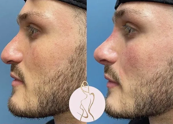 Real patient results before and after plastic surgery results in Long Island, NY, performed by Dr. Sotirios Papafragkou.