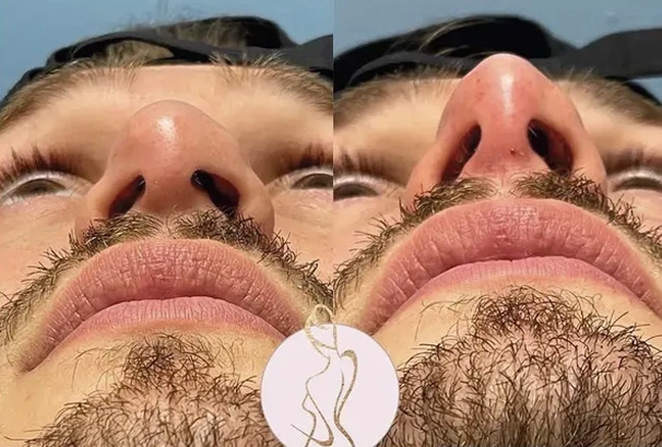 Real patient results before and after plastic surgery results in Long Island, NY, performed by Dr. Sotirios Papafragkou.