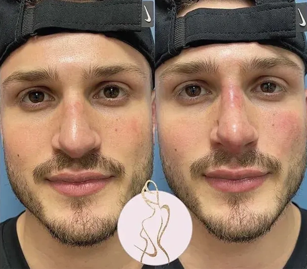 Real patient results before and after plastic surgery results in Long Island, NY, performed by Dr. Sotirios Papafragkou.