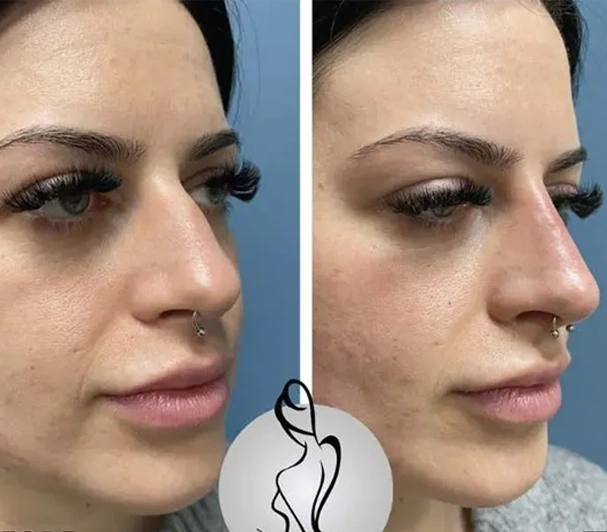Real patient results before and after plastic surgery results in Long Island, NY, performed by Dr. Sotirios Papafragkou.