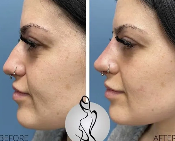 Real patient results before and after plastic surgery results in Long Island, NY, performed by Dr. Sotirios Papafragkou.