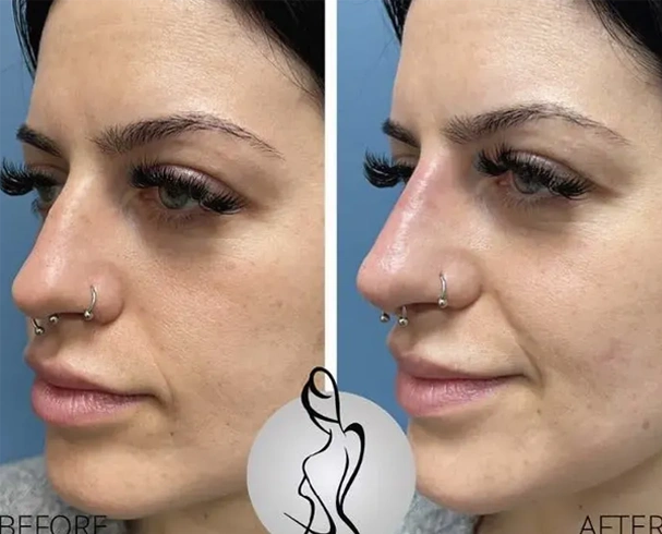 Real patient results before and after plastic surgery results in Long Island, NY, performed by Dr. Sotirios Papafragkou.