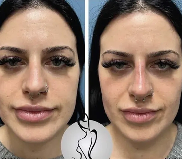 Real patient results before and after plastic surgery results in Long Island, NY, performed by Dr. Sotirios Papafragkou.