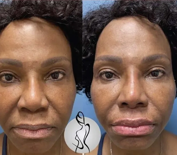 Real patient results before and after plastic surgery results in Long Island, NY, performed by Dr. Sotirios Papafragkou.