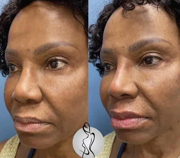 Real patient results before and after plastic surgery results in Long Island, NY, performed by Dr. Sotirios Papafragkou.