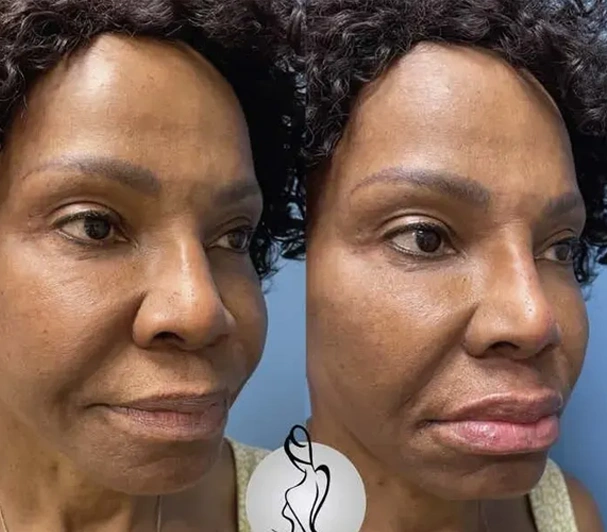 Real patient results before and after plastic surgery results in Long Island, NY, performed by Dr. Sotirios Papafragkou.