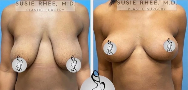 Real patient results before and after plastic surgery results in Long Island, NY, performed by Dr. Sotirios Papafragkou.