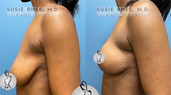 Real patient results before and after plastic surgery results in Long Island, NY, performed by Dr. Sotirios Papafragkou.