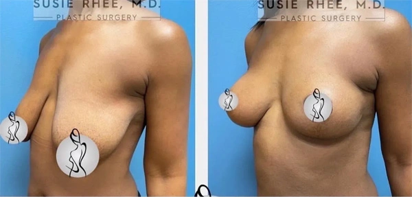 Real patient results before and after plastic surgery results in Long Island, NY, performed by Dr. Sotirios Papafragkou.