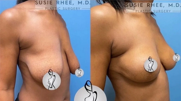 Real patient results before and after plastic surgery results in Long Island, NY, performed by Dr. Sotirios Papafragkou.
