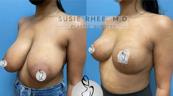 Real patient results before and after plastic surgery results in Long Island, NY, performed by Dr. Sotirios Papafragkou.