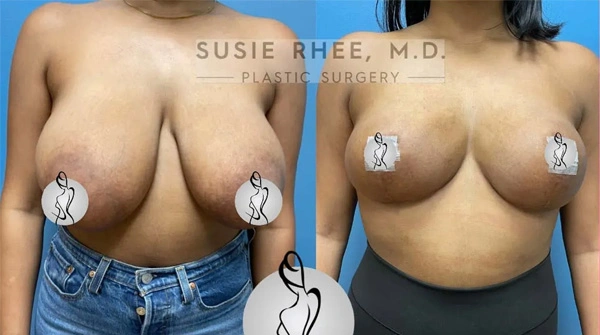 Real patient results before and after plastic surgery results in Long Island, NY, performed by Dr. Sotirios Papafragkou.