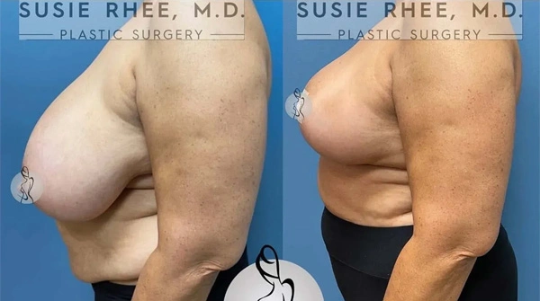Real patient results before and after plastic surgery results in Long Island, NY, performed by Dr. Sotirios Papafragkou.