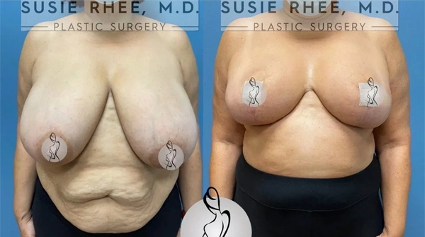 Real patient results before and after plastic surgery results in Long Island, NY, performed by Dr. Sotirios Papafragkou.