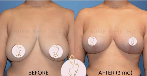 Real patient results before and after plastic surgery results in Long Island, NY, performed by Dr. Sotirios Papafragkou.