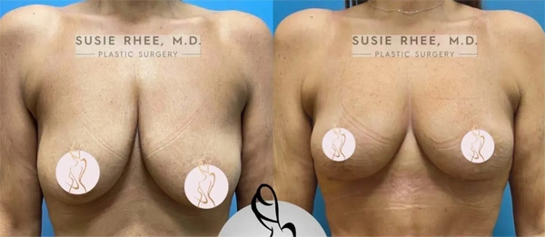 Real patient results before and after plastic surgery results in Long Island, NY, performed by Dr. Sotirios Papafragkou.