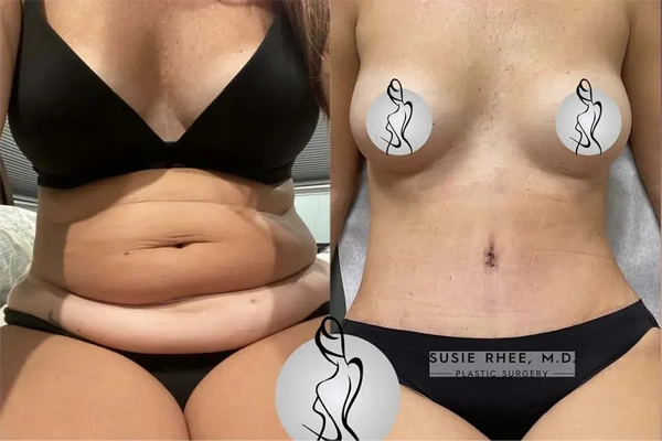 Real patient results before and after plastic surgery results in Long Island, NY, performed by Dr. Sotirios Papafragkou.