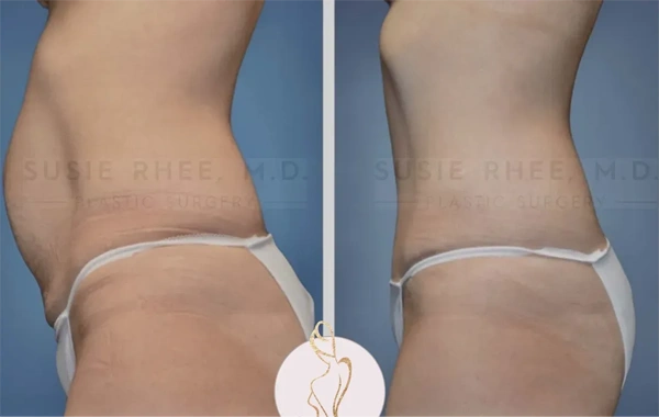Real patient results before and after plastic surgery results in Long Island, NY, performed by Dr. Sotirios Papafragkou.