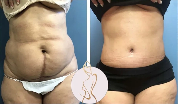 Real patient results before and after plastic surgery results in Long Island, NY, performed by Dr. Sotirios Papafragkou.