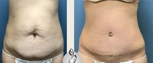 Real patient results before and after plastic surgery results in Long Island, NY, performed by Dr. Sotirios Papafragkou.