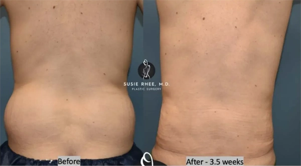 Real patient results before and after plastic surgery results in Long Island, NY, performed by Dr. Sotirios Papafragkou.